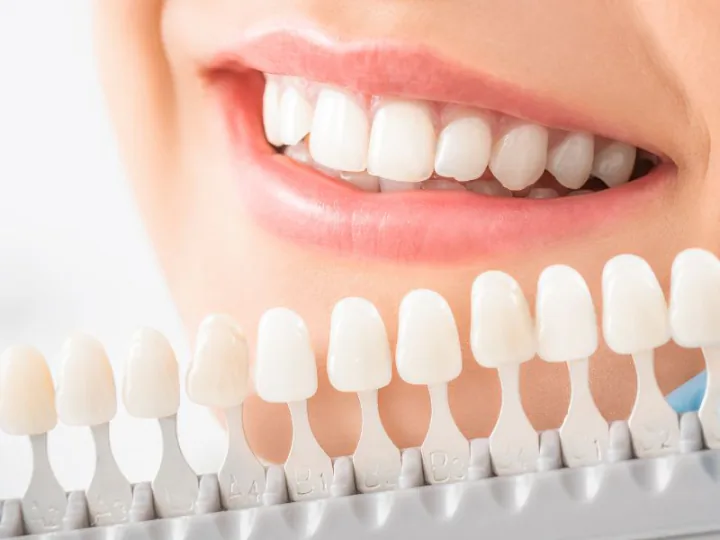 Muestrario de tonos dentales utilizado para valorar un blanqueamiento.