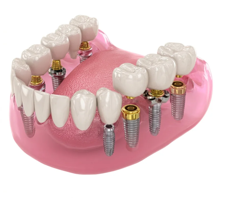 Modelo tridimensional de distintas soluciones con implantes dentales.